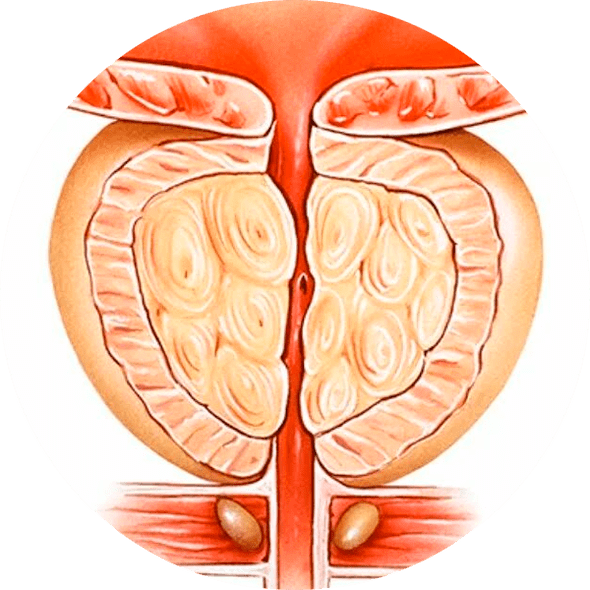 Consequences of untreated prostatitis