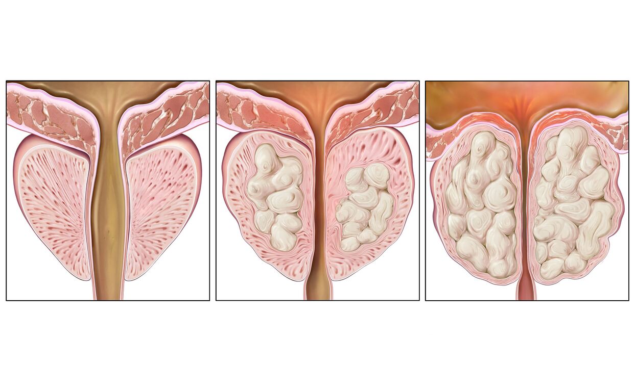 Prostate cancer staging