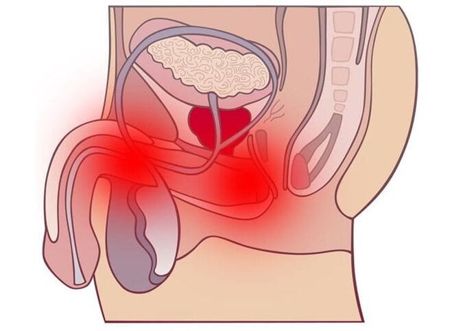 Prostatitis treatment methods