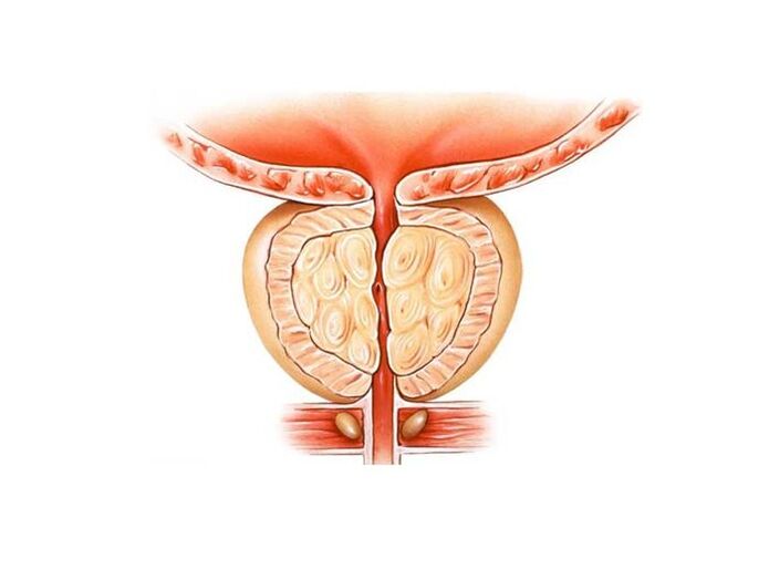 Treat prostatitis with folk remedies