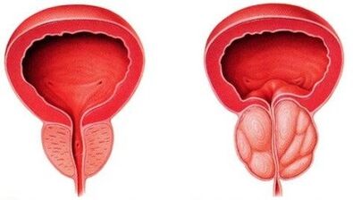 A healthy and inflamed prostate (with prostatitis)